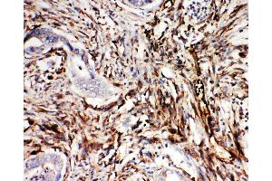 Anti-NRG1 antibody, IHC(P) IHC(P): Human Intestinal Cancer Tissue