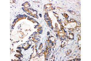 Anti-FGFR3 antibody, IHC(P) IHC(P): Human Intestinal Cancer Tissue (FGFR3 anticorps  (N-Term))