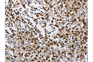 The image on the left is immunohistochemistry of paraffin-embedded Human esophagus cancer tissue using ABIN7128978(CMTM2 Antibody) at dilution 1/60, on the right is treated with fusion protein. (CMTM2 anticorps)