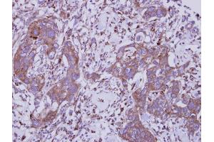IHC-P Image Immunohistochemical analysis of paraffin-embedded human breast cancer, using TLR5, antibody at 1:250 dilution. (TLR5 anticorps  (N-Term))