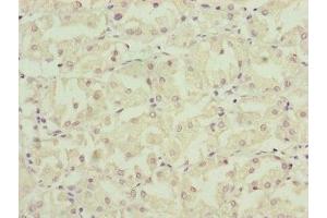 Immunohistochemistry of paraffin-embedded human gastric cancer using ABIN7160891 at dilution of 1:100 (NDUFA12 anticorps  (AA 1-145))