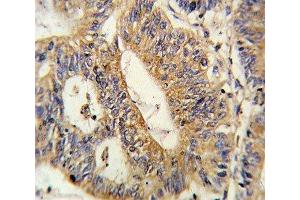IHC analysis of FFPE human colon carcinoma stained with IL17RB antibody (IL17 Receptor B anticorps  (AA 207-234))