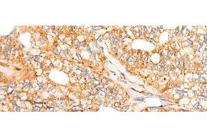 Immunohistochemistry of paraffin-embedded Human gastric cancer tissue using CHCHD3 Polyclonal Antibody at dilution of 1:45(x200) (CHCHD3 anticorps)