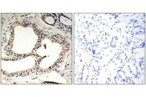 Immunohistochemical analysis of paraffin-embedded human breast carcinoma tissue using IkB-e(Phospho-Ser22) Antibody(left) or the same antibody preincubated with blocking peptide(right). (NFKBIE anticorps  (pSer22))