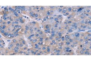 Immunohistochemistry of paraffin-embedded Human liver cancer tissue using NR1D1 Polyclonal Antibody at dilution 1:60 (NR1D1 anticorps)