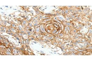 Immunohistochemistry of paraffin-embedded Human esophagus cancer tissue using SCN10A Polyclonal Antibody at dilution 1:25