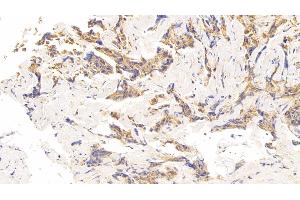 Detection of CDKN1A in Human Breast cancer Tissue using Polyclonal Antibody to Cyclin Dependent Kinase Inhibitor 1A (CDKN1A)