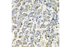 Immunohistochemistry of paraffin-embedded human lung cancer using ADSS antibody (ABIN6131467, ABIN6136604, ABIN6136606 and ABIN6216015) at dilution of 1:100 (40x lens).