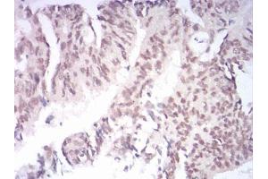Immunohistochemical analysis of paraffin-embedded rectum cancer tissues using AOF1 mouse mAb with DAB staining. (KDM1B anticorps  (AA 6-129))
