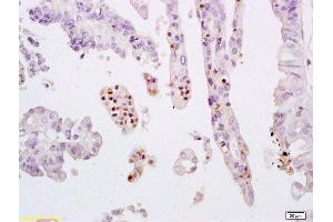 Formalin-fixed and paraffin embedded human breast carcinoma labeled with Anti-phospho-STAT3 (Tyr705) Polyclonal Antibody, Unconjugated (ABIN732638) at 1:200 followed by conjugation to the secondary antibody and DAB staining.