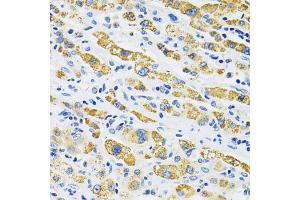 Immunohistochemistry of paraffin-embedded human liver cancer using SLC16A4 antibody. (SLC16A4 anticorps)