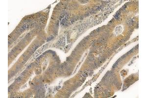 ABIN6261832 and ABIN6276853 at 1/100 staining human colon carcinoma by IHC-P. (Frataxin anticorps  (Internal Region))
