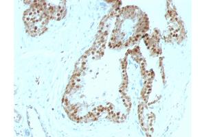 Formalin-fixed, paraffin-embedded human Prostate Carcinoma stained with p57 Mouse Monoclonal Antibody (KIP2/880). (CDKN1C anticorps)