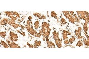 Immunohistochemistry of paraffin-embedded Human gastric cancer tissue using ZBTB43 Polyclonal Antibody at dilution of 1:40(x200)