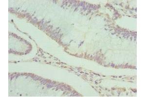 Immunohistochemistry of paraffin-embedded human colon cancer using ABIN7166867 at dilution of 1:100 (PDXK anticorps  (AA 1-312))