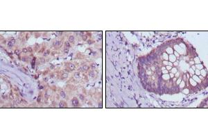 Immunohistochemical analysis of paraffin-embedded human liver cancer (left) and colorectal cancer tissues (right) using BDH1 mouse mAb with DAB staining. (BDH1 anticorps)