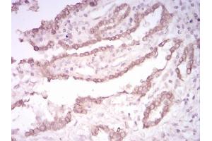 Immunohistochemical analysis of paraffin-embedded lung cancer tissues using CK5 mouse mAb with DAB staining.