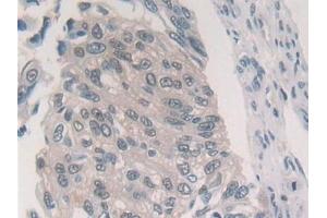 Detection of PSMb6 in Human Colorectal cancer Tissue using Polyclonal Antibody to Proteasome Subunit Beta Type 6 (PSMb6)