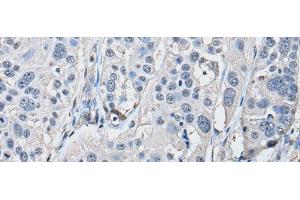 Immunohistochemistry of paraffin-embedded Human esophagus cancer tissue using PRKAR2A Polyclonal Antibody at dilution of 1:50(x200) (PRKAR2A anticorps)