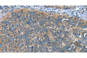 Immunohistochemistry of paraffin-embedded Human cervical cancer tissue using DTX1 Polyclonal Antibody at dilution 1:30 (Deltex Homolog 1 anticorps)