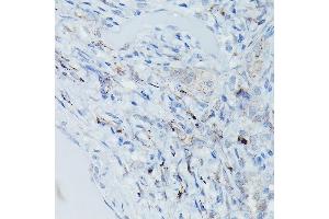 Immunohistochemistry of paraffin-embedded Human pulmonary tuberculosis using GSDME Rabbit pAb (ABIN6127757, ABIN6139554, ABIN6139555 and ABIN6223304) at dilution of 1:50 (40x lens). (Non-Syndromic Hearing Impairment Protein 5 (GSDME) (AA 1-260) anticorps)