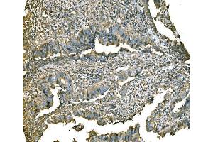 IHC analysis of PKM2 using anti-PKM2 antibody (ABIN3043381). (PKM anticorps  (N-Term))