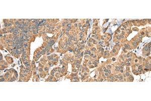 Immunohistochemistry of paraffin-embedded Human thyroid cancer tissue using NADK2 Polyclonal Antibody at dilution of 1:40(x200) (NADK2 anticorps)