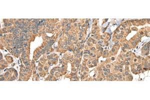 Immunohistochemistry of paraffin-embedded Human thyroid cancer tissue using NADK2 Polyclonal Antibody at dilution of 1:40(x200)