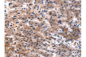 The image on the left is immunohistochemistry of paraffin-embedded Human liver cancer tissue using ABIN7128981(CNGA2 Antibody) at dilution 1/25, on the right is treated with fusion protein.