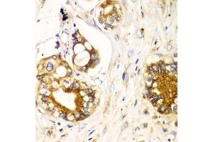 Immunohistochemistry of paraffin-embedded human liver cancer using RPN1 antibody. (RPN1 anticorps  (AA 20-280))
