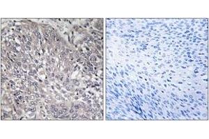 Immunohistochemistry analysis of paraffin-embedded human cervix carcinoma tissue, using InsP3R1 (Ab-1598/1588) Antibody. (ITPR1 anticorps  (AA 1566-1615))