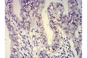 Immunohistochemical analysis of paraffin-embedded endometrial cancer tissues using ATXN1 mouse mAb with DAB staining. (Ataxin 1 anticorps  (AA 645-815))