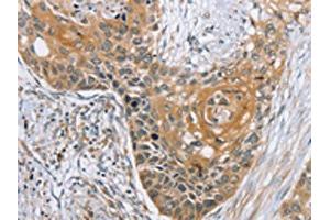 The image on the left is immunohistochemistry of paraffin-embedded Human esophagus cancer tissue using ABIN7192155(RBM38 Antibody) at dilution 1/35, on the right is treated with synthetic peptide. (RBM38 anticorps)