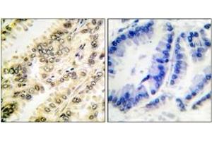Immunohistochemistry analysis of paraffin-embedded human breast carcinoma, using SGK (Phospho-Ser422) Antibody. (SGK1 anticorps  (pSer422))