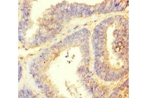 Immunohistochemistry of paraffin-embedded human endometrial cancer using ABIN7164621 at dilution of 1:100 (TTLL9 anticorps  (AA 1-230))
