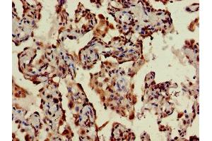 IHC image of ABIN7170794 diluted at 1:400 and staining in paraffin-embedded human lung cancer performed on a Leica BondTM system.