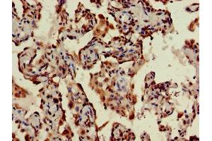 IHC image of ABIN7170794 diluted at 1:400 and staining in paraffin-embedded human lung cancer performed on a Leica BondTM system. (STING/TMEM173 anticorps  (AA 207-379))