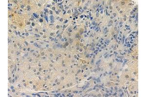 ABIN6265916 and ABIN6277797 at 1/100 staining human lung squamous cell carcinoma by IHC-P. (USP22 anticorps  (Internal Region))