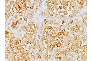 Formalin-fixed, paraffin-embedded human Melanoma stained with Melan-A Monoclonal Antibody (M2-9E3).