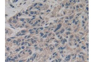 Detection of Slit2 in Human Lung cancer Tissue using Polyclonal Antibody to Slit Homolog 2 (Slit2)