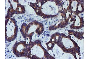 Immunohistochemical staining of paraffin-embedded Adenocarcinoma of Human colon tissue using anti-PDSS2 mouse monoclonal antibody. (PDSS2 anticorps)