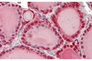 Detection of GSTp in Human Thyroid Tissue using Polyclonal Antibody to Glutathione S Transferase Pi (GSTp)
