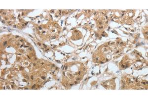 Immunohistochemistry of paraffin-embedded Human lung cancer using Amphiphysin I Polyclonal Antibody at dilution of 1:30 (Amphiphysin anticorps)
