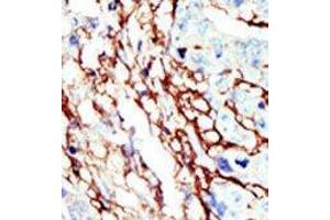Formalin-fixed and paraffin-embedded human cancer tissue reacted with the primary antibody, which was peroxidase-conjugated to the secondary antibody, followed by AEC staining. (EPH Receptor A7 anticorps  (C-Term))