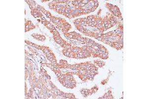 Immunohistochemistry of paraffin-embedded Human thyroid cancer using CDC20 antibody (ABIN7266246) at dilution of 1:100 (40x lens).