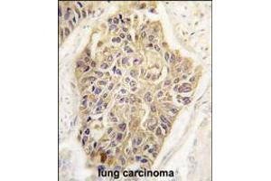 Formalin-fixed and paraffin-embedded human lung carcinoma tissue reacted with MAGEA1 Antibody , which was peroxidase-conjugated to the secondary antibody, followed by DAB staining. (MAGEA1 anticorps  (AA 143-173))