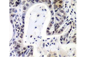 Immunohistochemistry of paraffin-embedded Human gastric cancer using LSM2 Polyclonal Antibody at dilution of 1:100 (40x lens). (LSM2 anticorps)