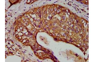 IHC image of ABIN7157412 diluted at 1:400 and staining in paraffin-embedded human cervical cancer performed on a Leica BondTM system.
