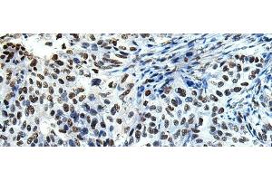 Immunohistochemistry of paraffin-embedded Human esophagus cancer tissue using DDX39A Polyclonal Antibody at dilution of 1:65(x200)