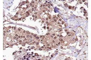 ABIN6267626 at 1/100 staining human colon carcinoma tissue sections by IHC-P.